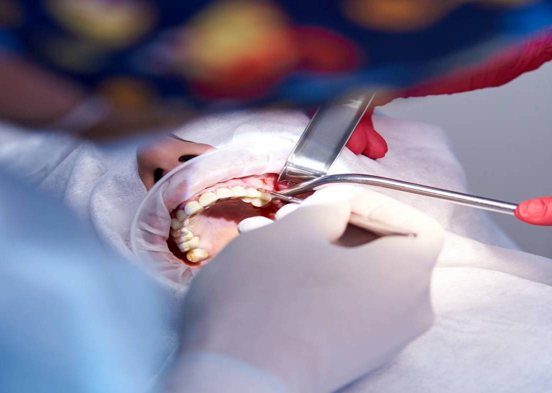 sinüs lifting uygulaması