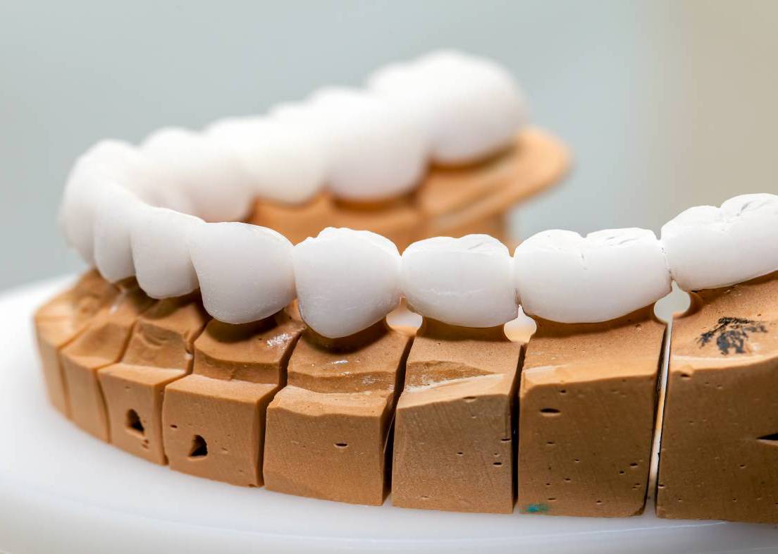 zirkonyum lamine uygulaması